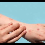 Monkeypox-1698742849